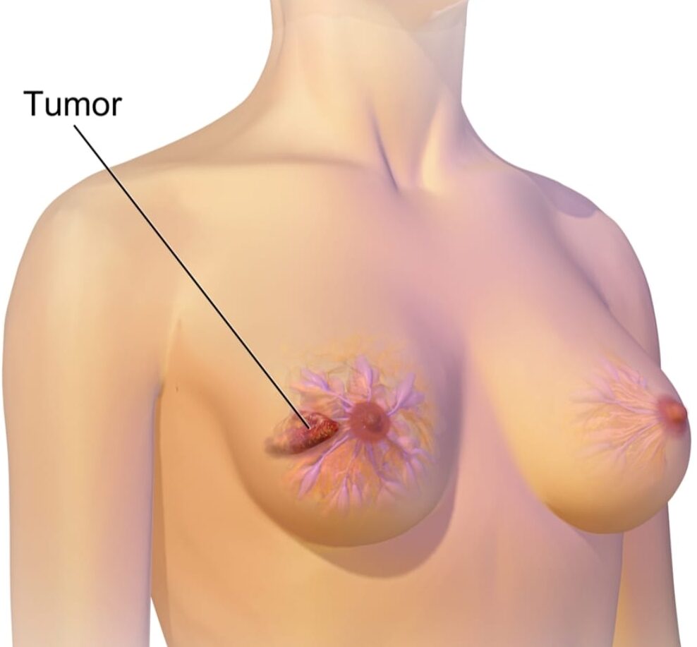 ഗർഭാശയ ഗള അർബുദ വിമുക്ത കേരളം ലക്ഷ്യം