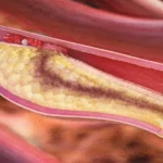 കൊളസ്ട്രോൾ നില ആരോഗ്യകരമായി നിലനിർത്താൻ ശ്രദ്ധിക്കേണ്ട ഏഴ് പ്രധാന കാര്യങ്ങൾ